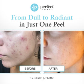 Perfect Image professional application on hand demonstrating controlled treatment
