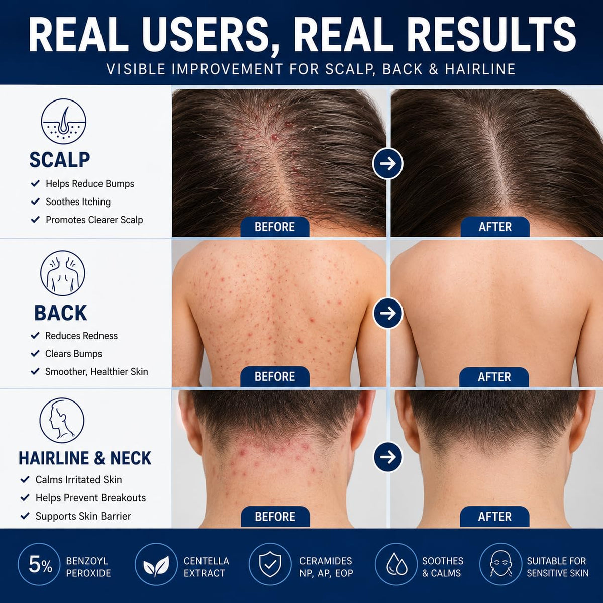Peunitory being applied to scalp bumps demonstrating targeted spot treatment benefit