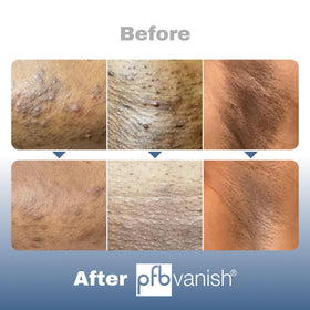 PFB Vanish applied to bikini line showing gentle soothing benefit after hair removal