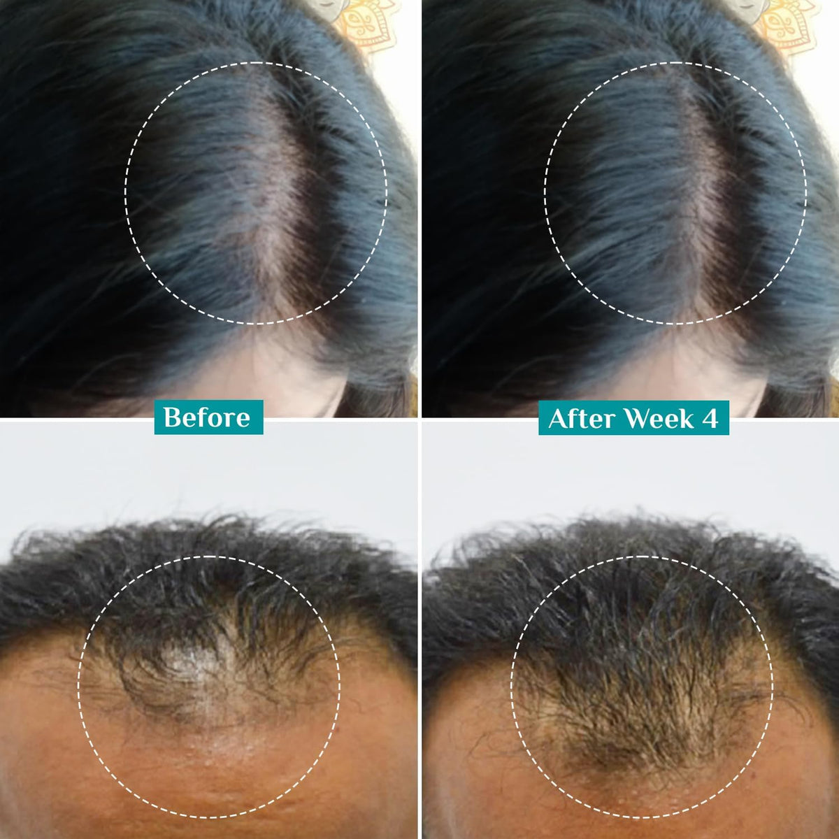 Pilgrim serum applied to scalp demonstrating targeted follicle treatment