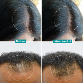 Pilgrim serum applied to scalp demonstrating targeted follicle treatment