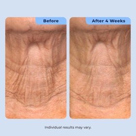 Plexaderm close droplet of hyaluronic acid illustrating hydration and plumping benefit