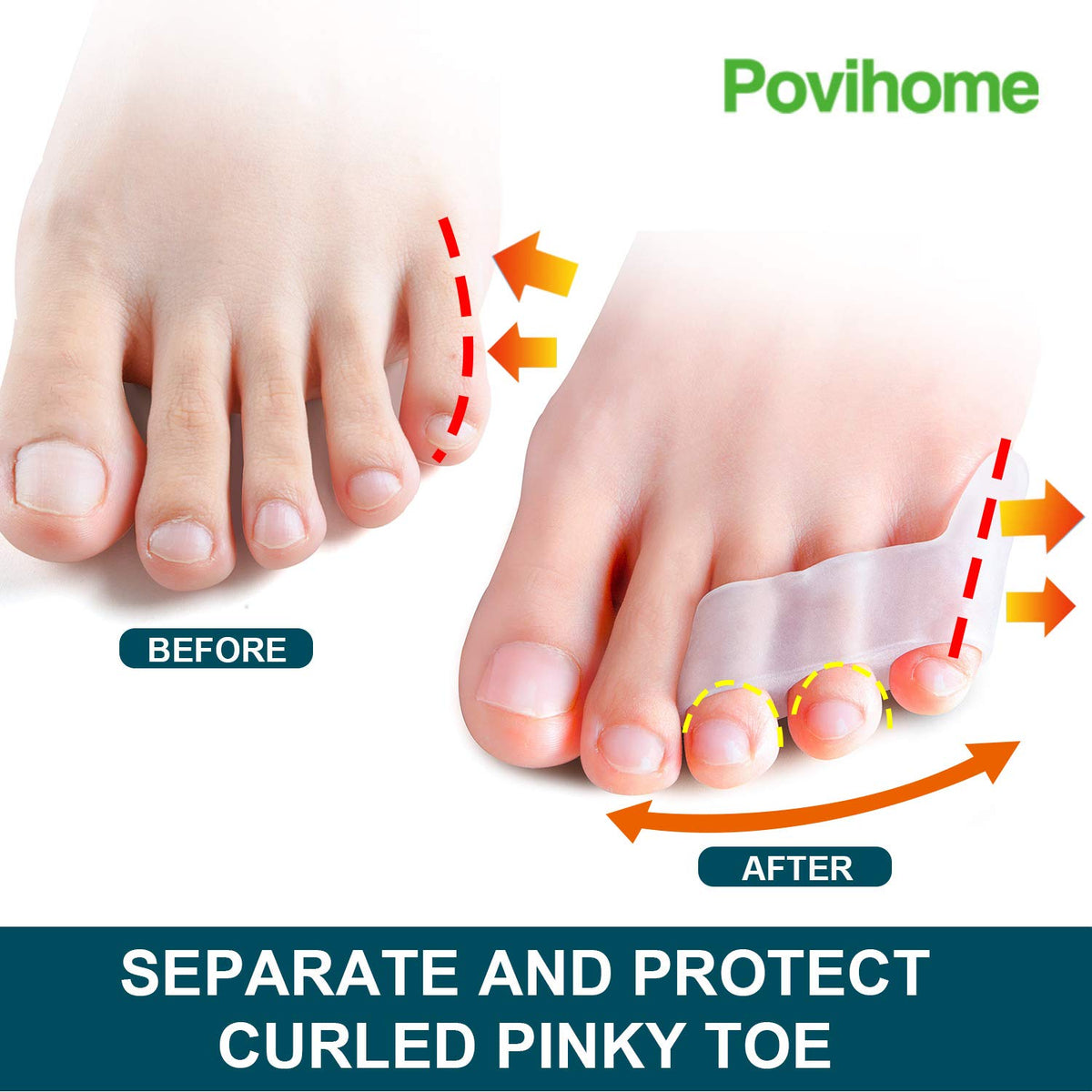Povihome toe spacers worn under a sock showing comfortable fit