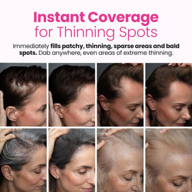 Prime Prometics before and after hairline comparison illustrating fuller, smoother appearance