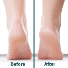 Probelle file in use on heel demonstrating efficient callus removal