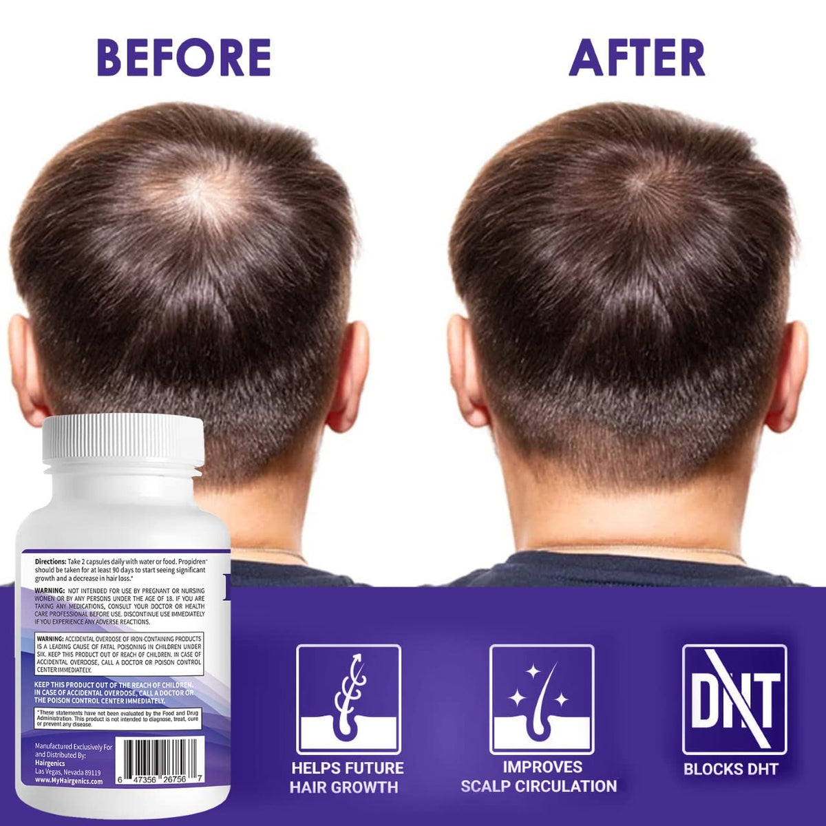 Pronexa Propidren paired with hair loss shampoo illustrating combined regimen benefit