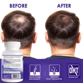 Pronexa Propidren paired with hair loss shampoo illustrating combined regimen benefit