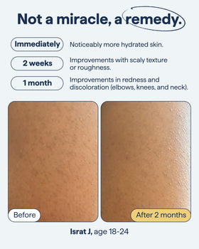 Remedy Science applied to arm showing how to treat textured areas