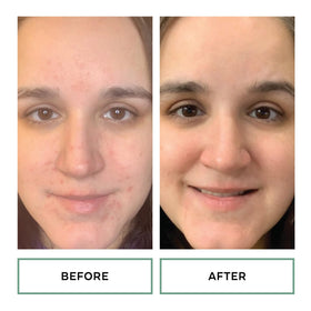 Hand applying Replenix pad to cheek demonstrating easy, no-rinse use