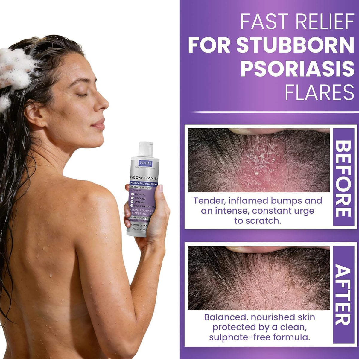 Rida Hair Research Institute dandruff brush paired with shampoo for improved exfoliation