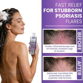 Rida Hair Research Institute dandruff brush paired with shampoo for improved exfoliation