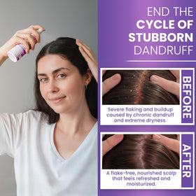 Rida Hair Research Institute Neoketramin being applied to scalp to soothe flakes and itch