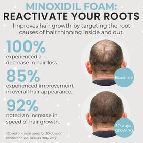 Rida Remixidil application on scalp illustrating targeted delivery to thinning areas for better coverage