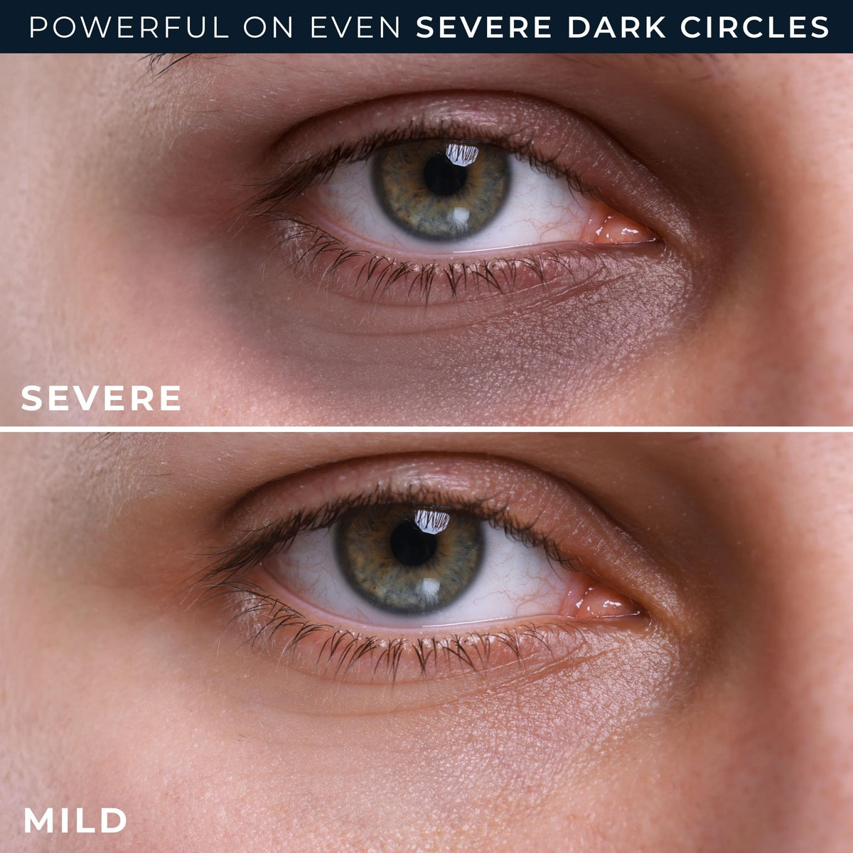 RoC application under eye showing reduced puffiness effect