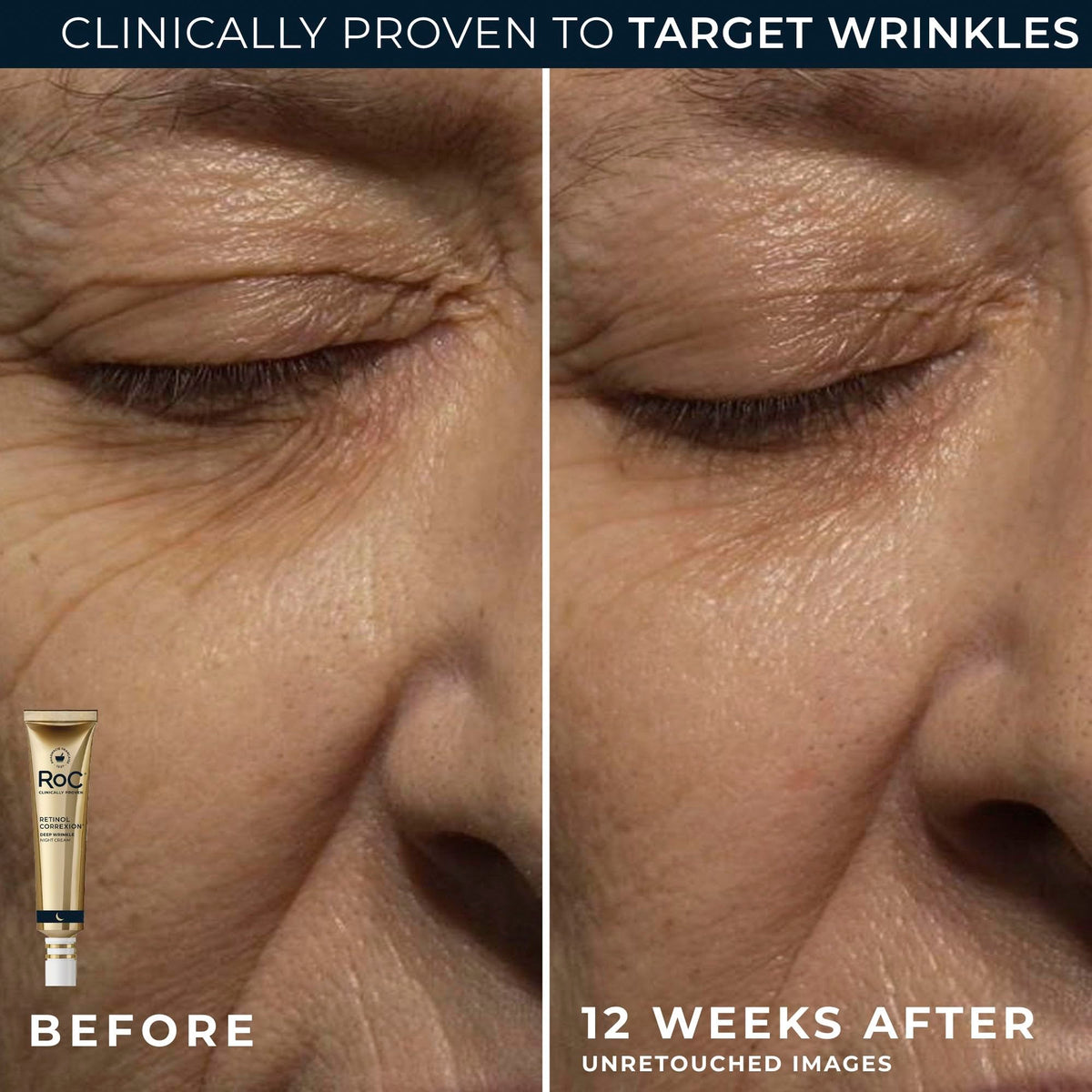 RoC eye cream on fingertip ready for precise under-eye application reducing puffiness