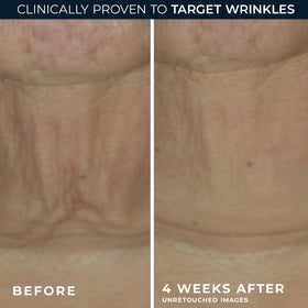RoC neck and jawline usage showing targeted lift and contouring benefit
