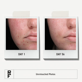 RODAN + FIELDS acne wash pump close-up highlighting easy dispensing and hygienic use