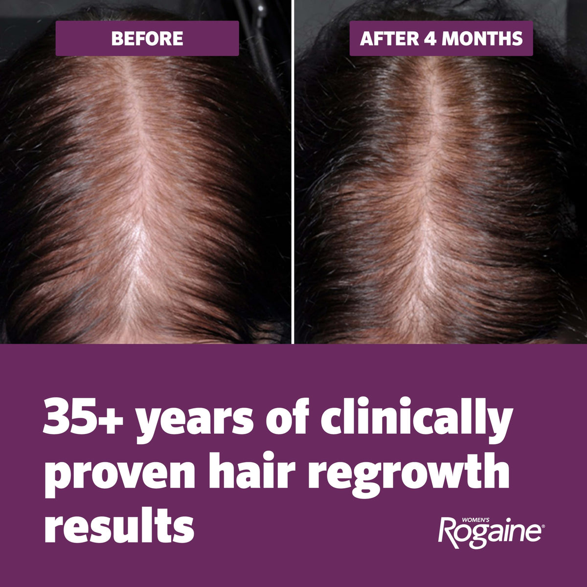 Rogaine foam being applied to scalp for targeted treatment
