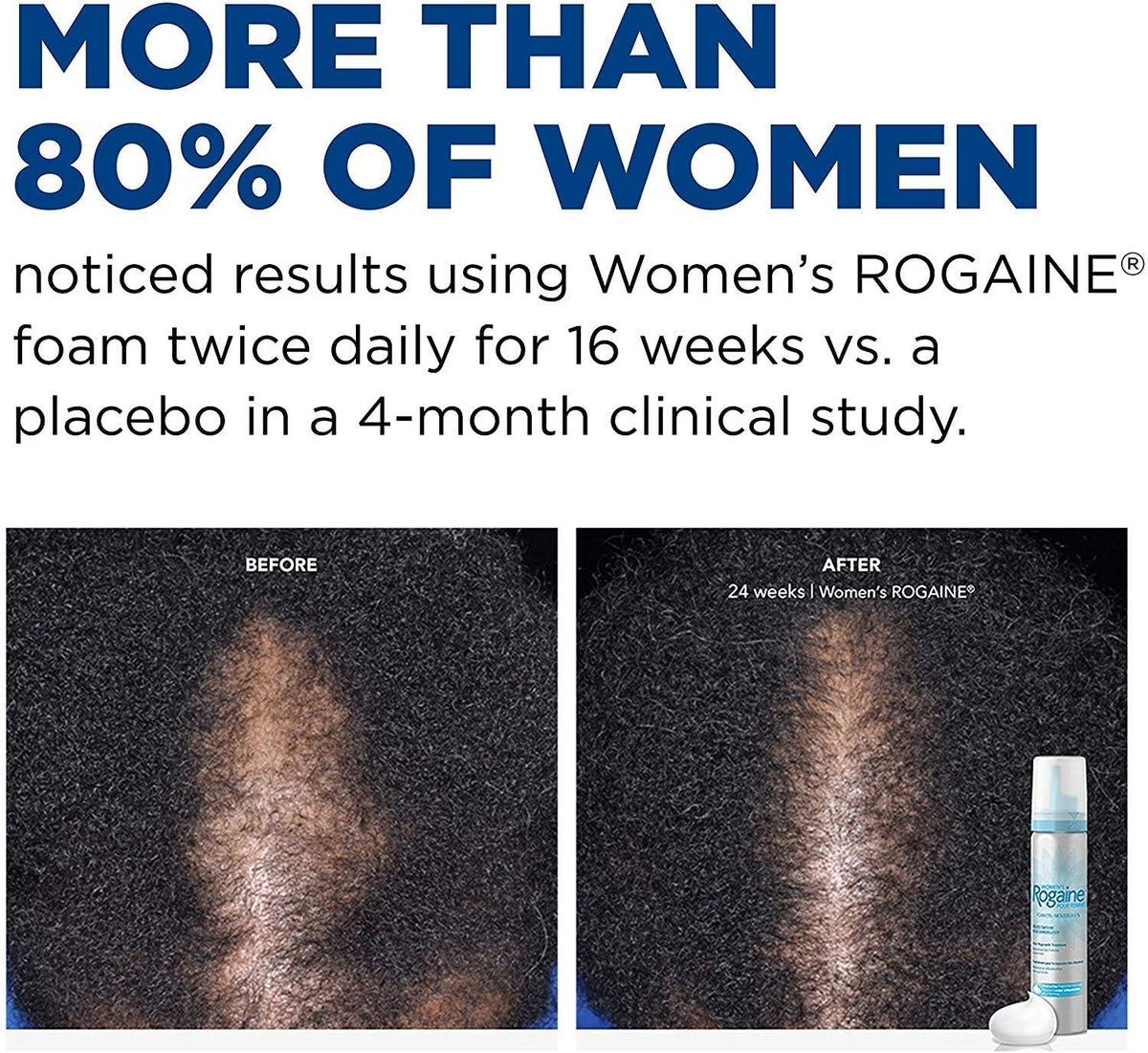 Rogaine bottle with foam emerging to highlight texture and absorbency