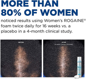 Rogaine bottle with foam emerging to highlight texture and absorbency