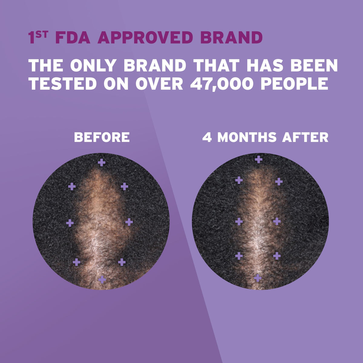 Rogaine bottle cap and measurement showing correct half-cap dosage