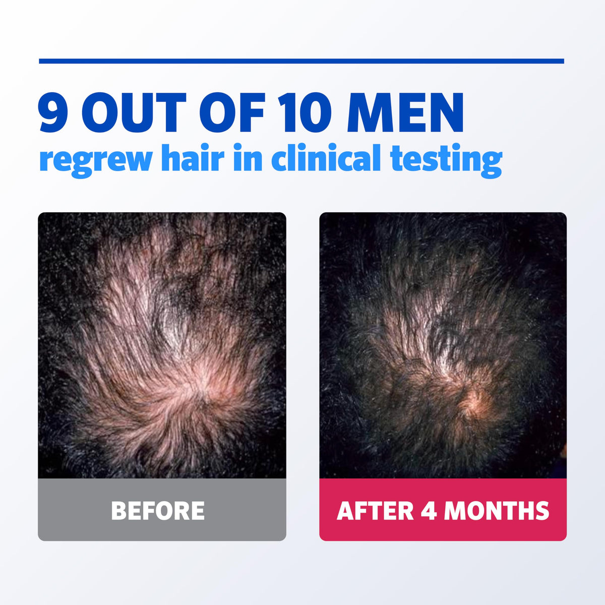 Rogaine foam being applied to scalp showing targeted thinning coverage