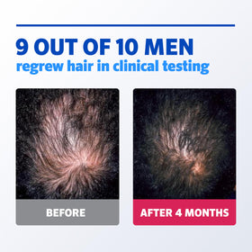 Rogaine foam being applied to scalp showing targeted thinning coverage
