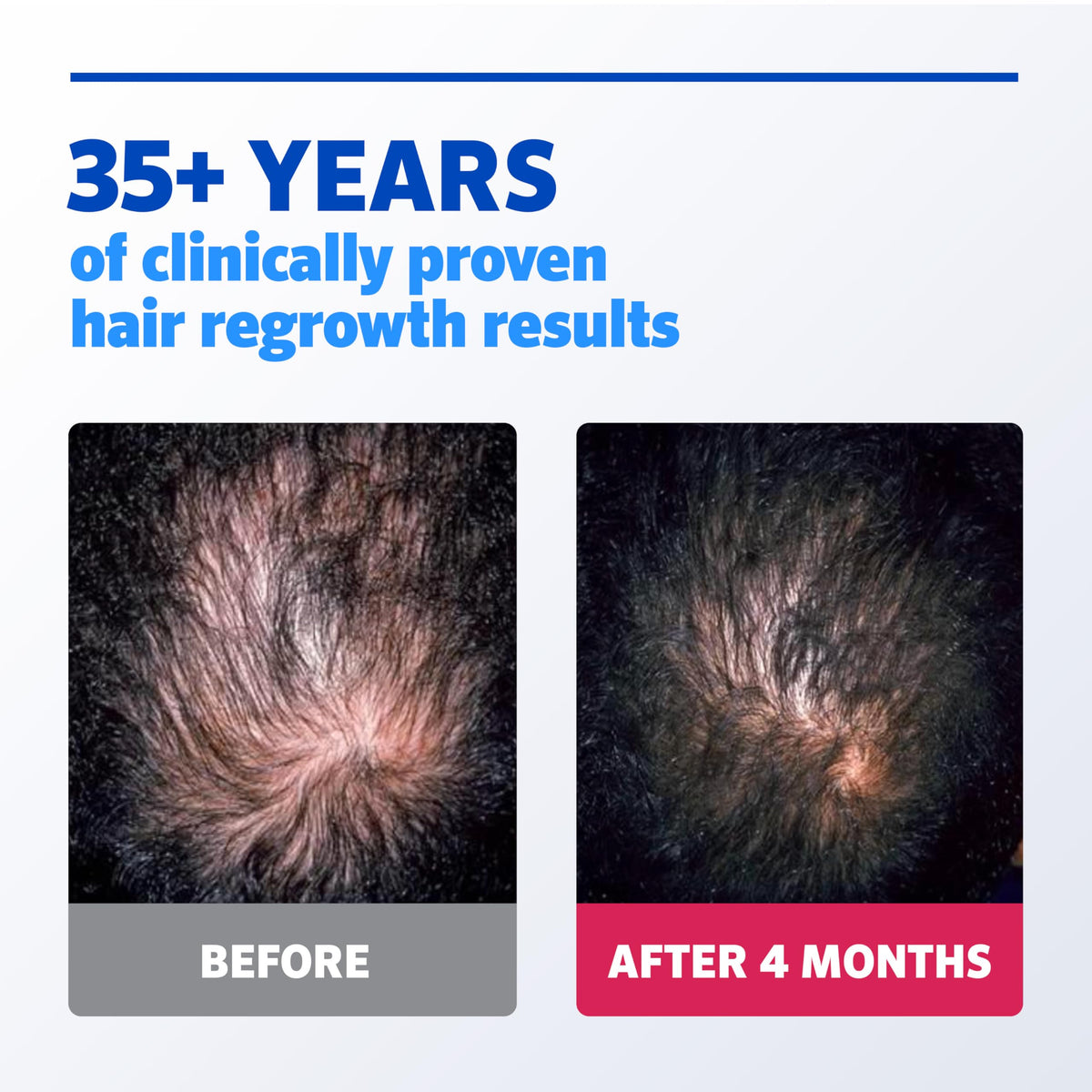 Model applying Rogaine to thinning scalp to show correct placement and routine use
