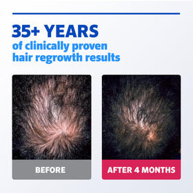 Model applying Rogaine to thinning scalp to show correct placement and routine use