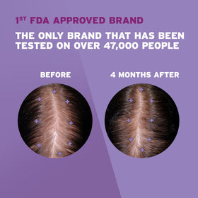 Rogaine in-use close-up applying to scalp demonstrating targeted treatment benefit