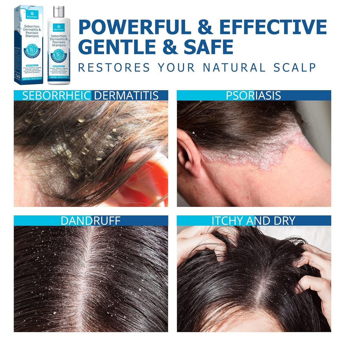 Roycederm before and after scalp visualization showing reduced flakes benefit