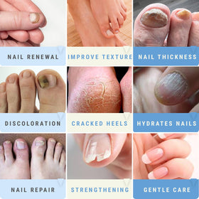 Scientific Solutions Global before and after toenail comparison demonstrating visible nail improvement