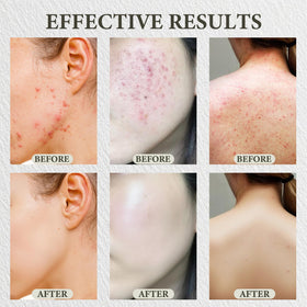 SDXJIOGE application on face demonstrating targeted spot care and reduced redness benefit