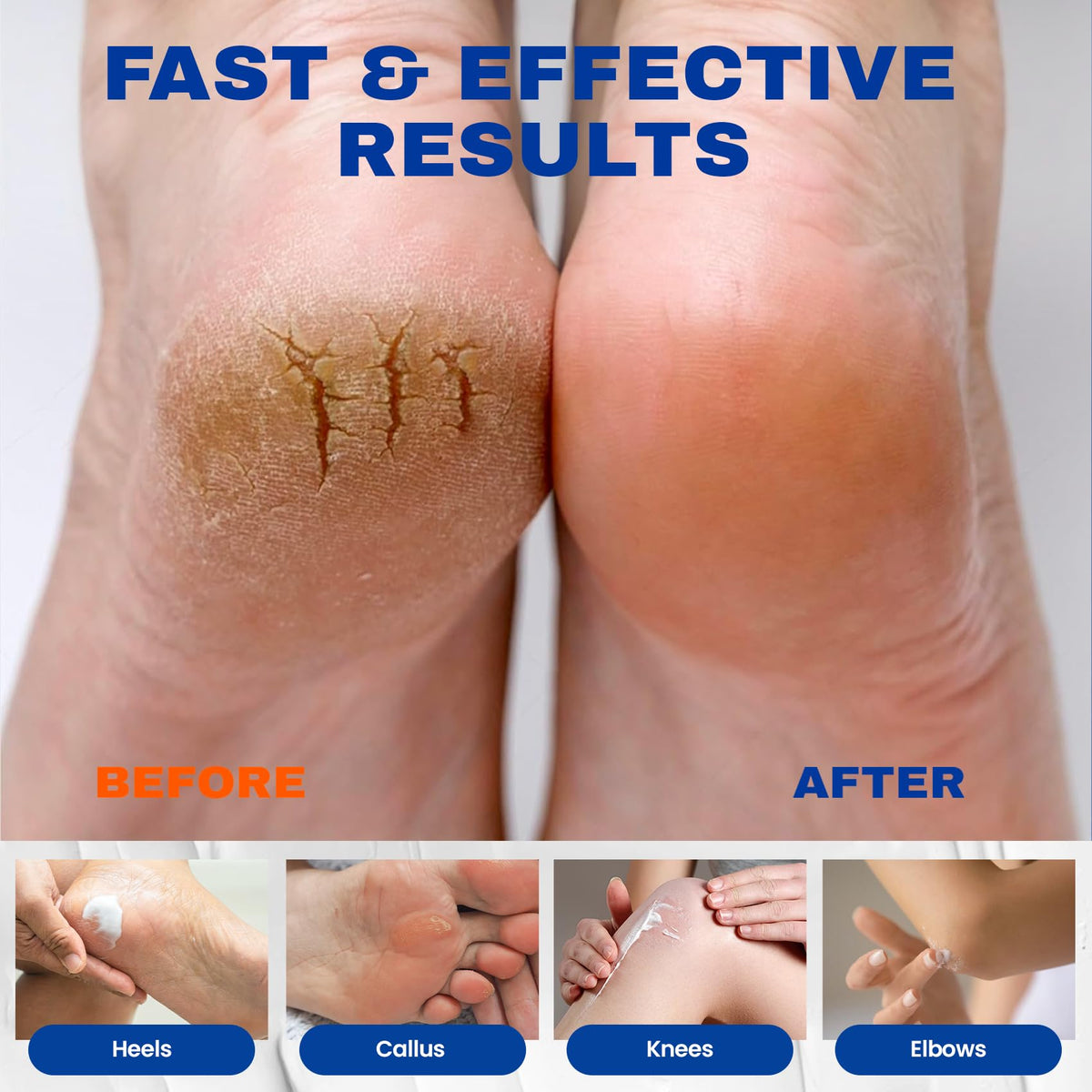 SKIN ULTIMA being applied to heel demonstrating targeted hydration and softening