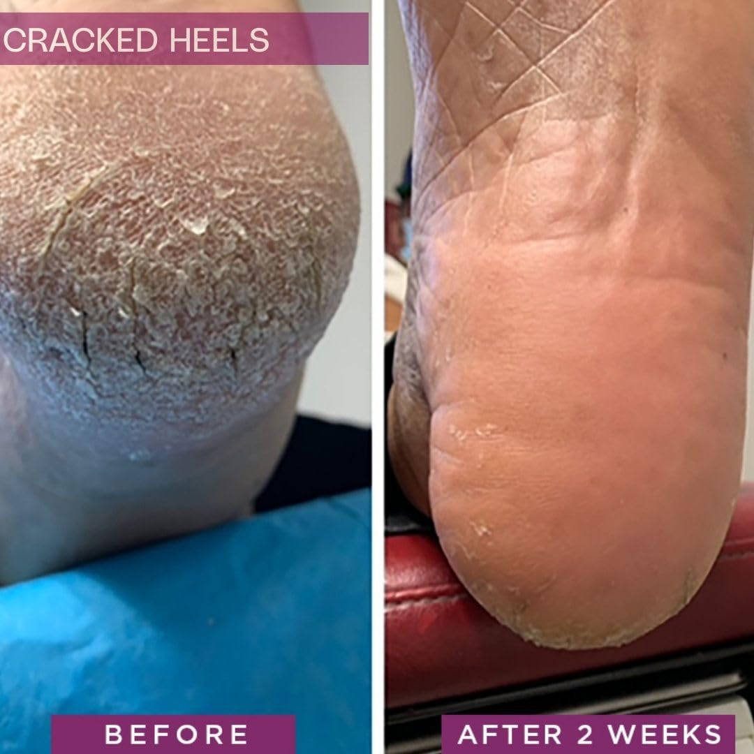 SkinIntegra being applied to cracked heel illustrating targeted hydration and fast relief