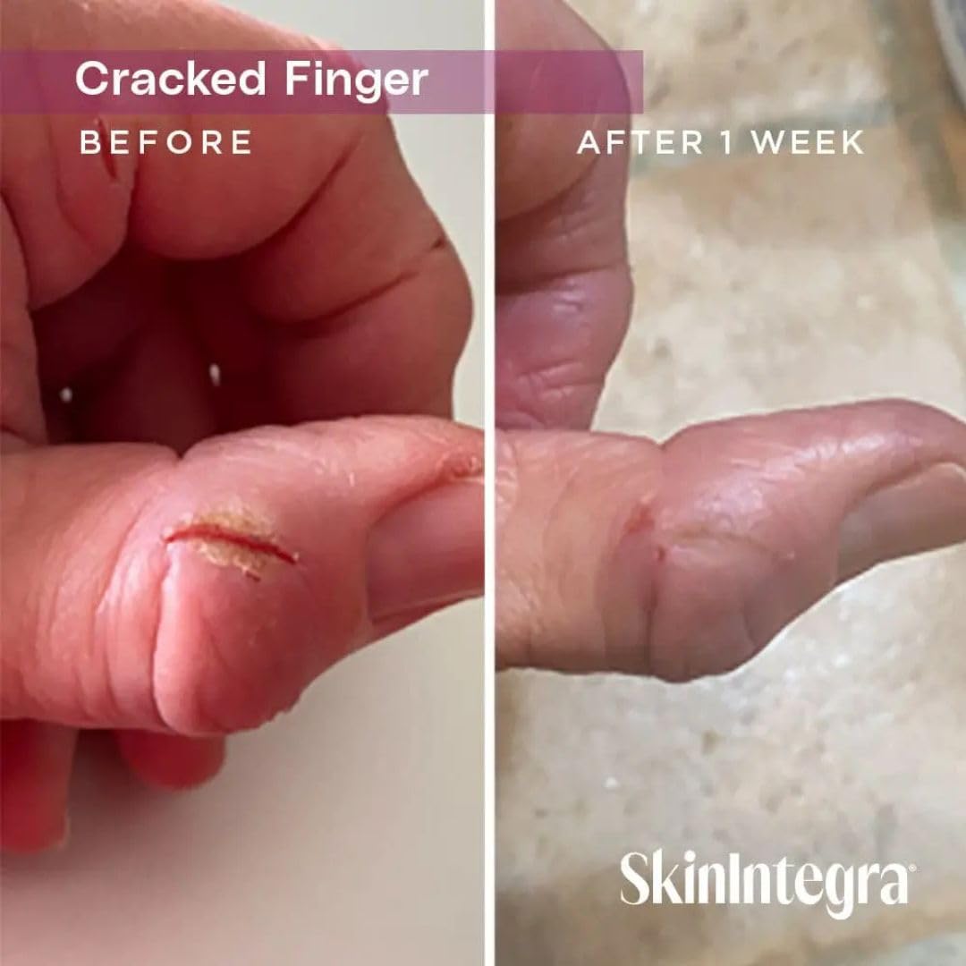 SkinIntegra tube in hand for size comparison and easy portability benefit