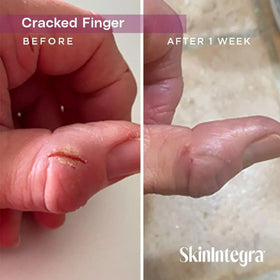 SkinIntegra tube in hand for size comparison and easy portability benefit
