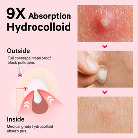 Sosky patches applied on cheek blending into skin for discreet coverage