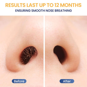 SUERBEATY applicator in use in nostril demonstrating precise reach