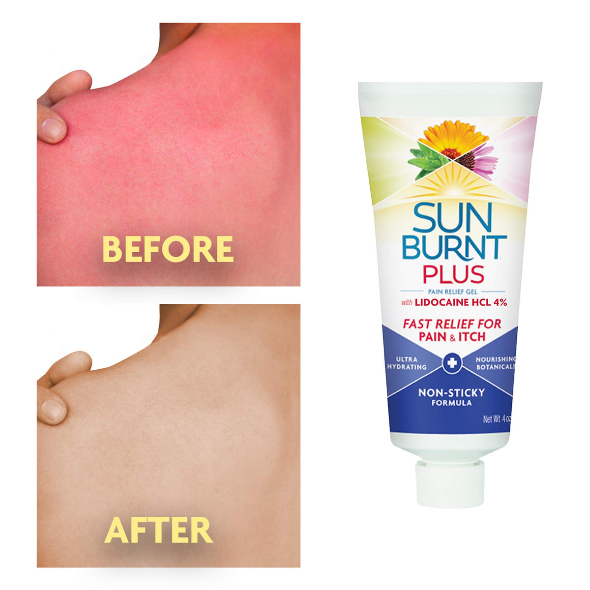 Sunburnt gel spread on palm providing immediate cooling relief