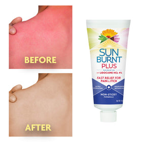 Sunburnt gel spread on palm providing immediate cooling relief