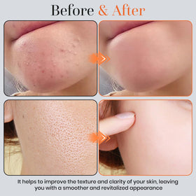 T.Chilyn application on face demonstrating mild enzyme action benefit