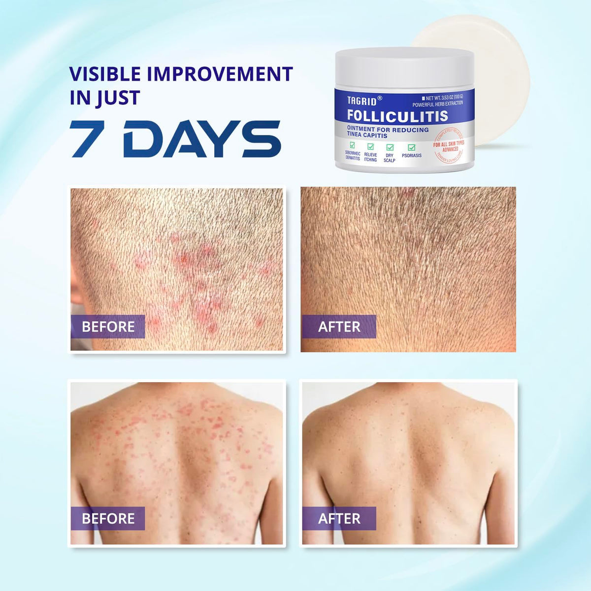 TAGRID used on scalp demonstrating targeted follicle relief and calming