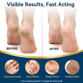 Taoscare being applied to a cracked heel demonstrating targeted repair and moisturizing benefit
