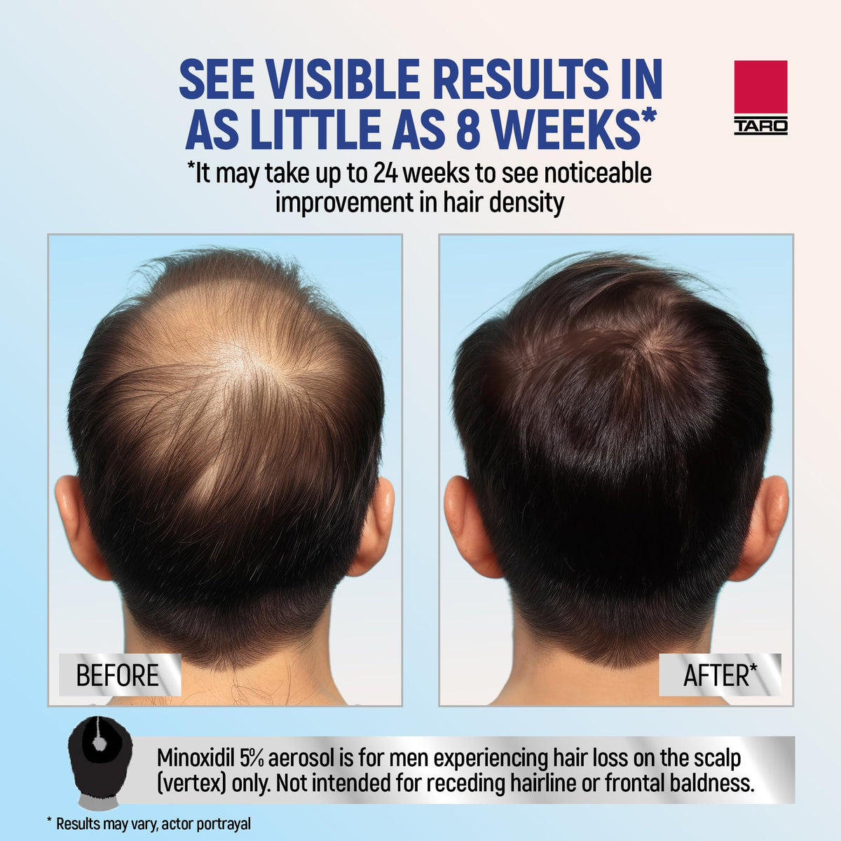 TARO application on scalp demonstration image, showing targeted coverage benefit