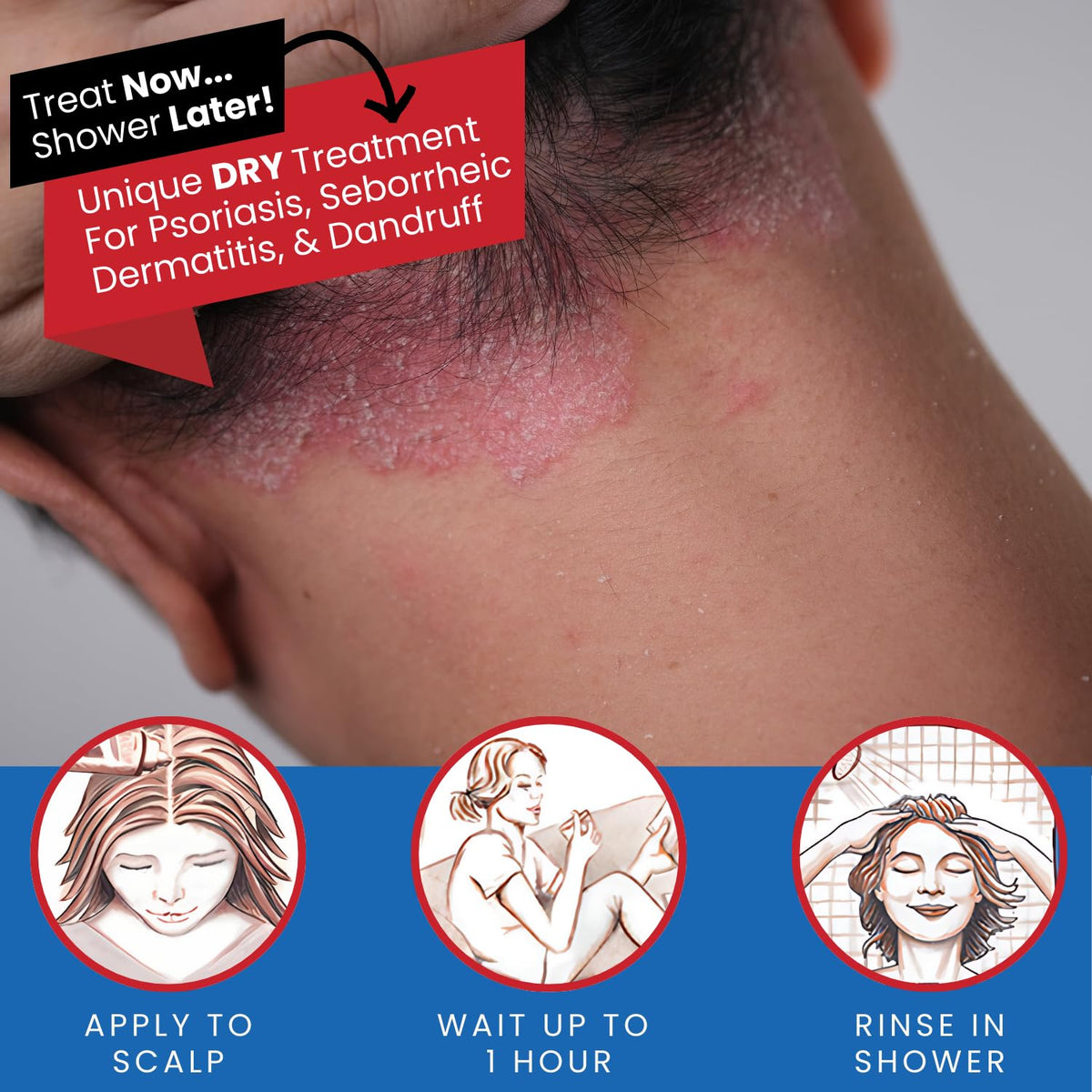 Tarsum being applied to dry scalp demonstrating targeted relief
