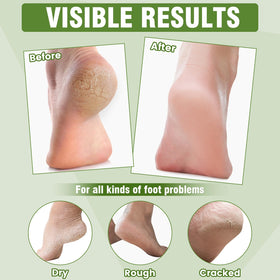 TEAWOO foot mask worn on foot demonstrating comfortable, mess-free use