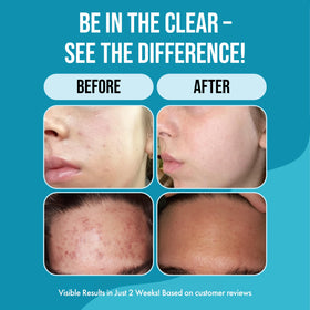 Teenology in-shower use rinsing clean to reduce pore-clogging residue
