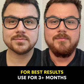 The Beard Club before and after comparison showing fuller beard appearance