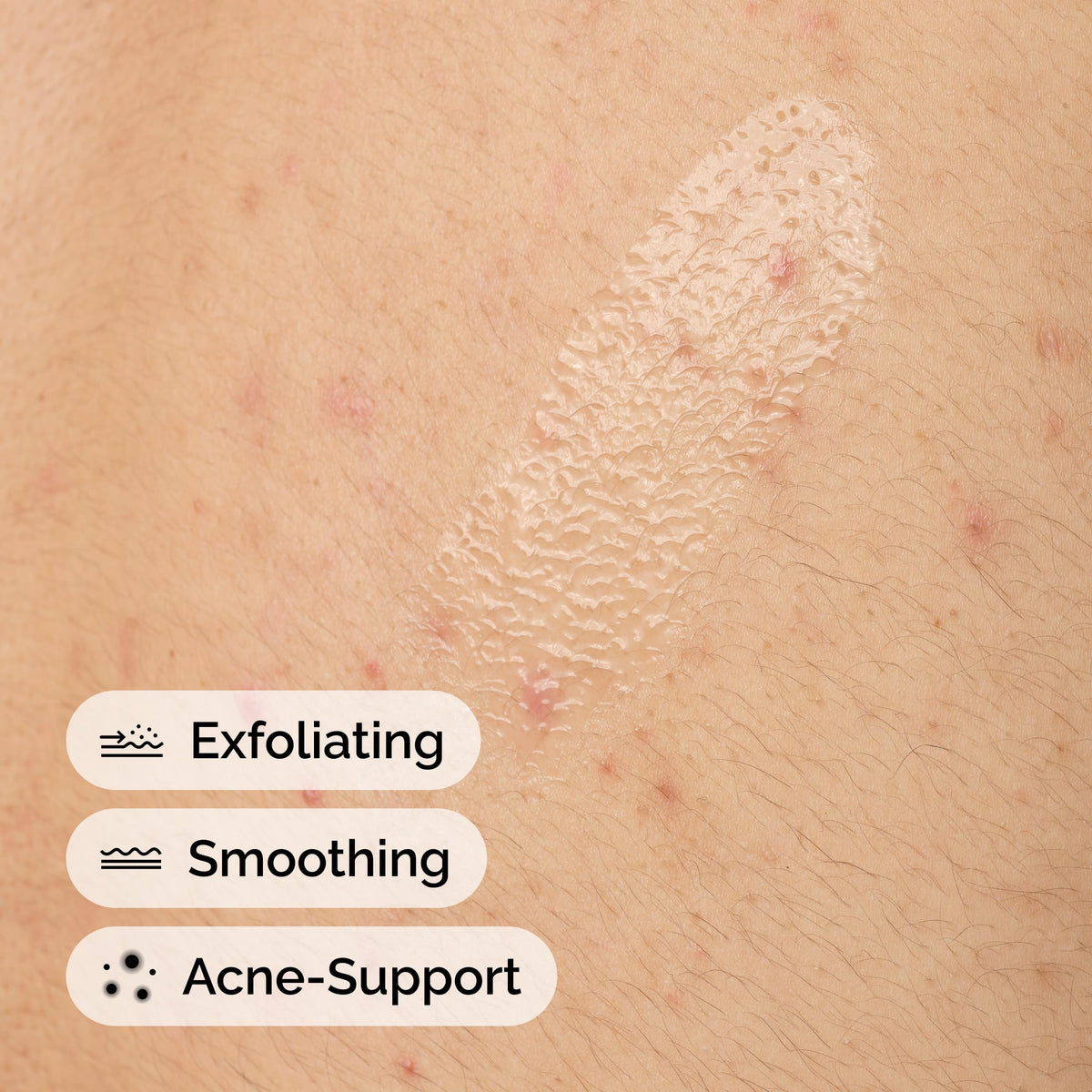 The Ordinary applying serum to upper back showing targeted acne control benefit